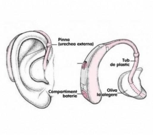 Aparat auditiv pentru hipoacuzie severa